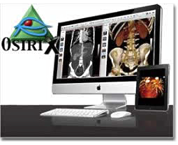 医療用画像処理ソフト（OsiriX）